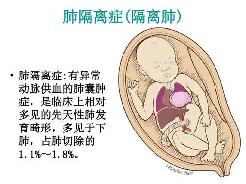 肺隔离症的麻醉ppt