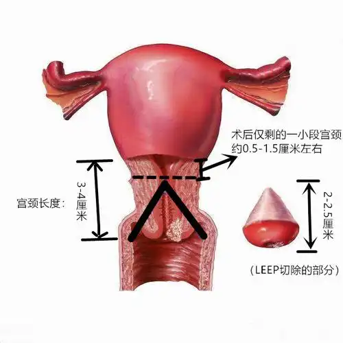 5cm.3,cin3级切除宽度为2-2.5cm,超出碘示区0.5cm.