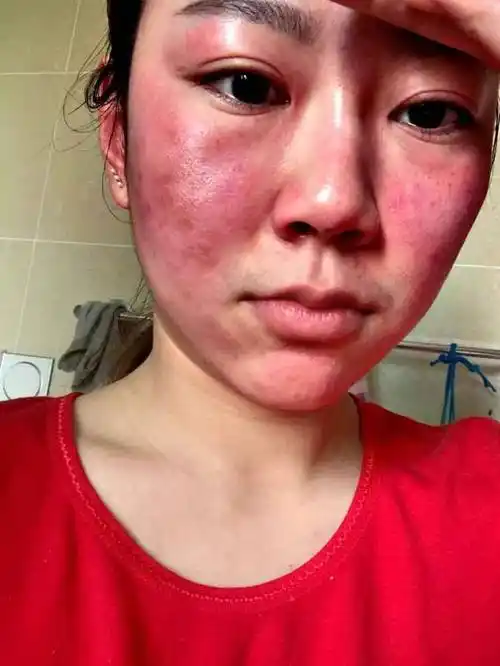 打了各种化妆品的成分也不一相同,因此就很容易造成过敏,而本身就是