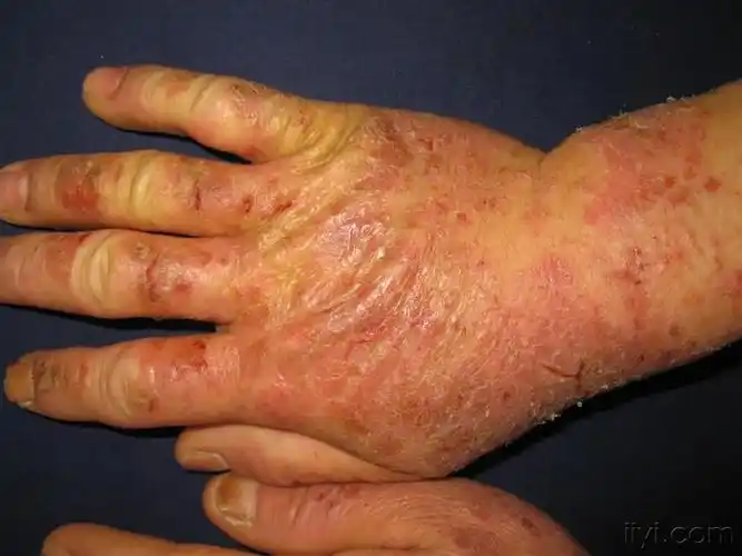 看图识病接触性皮炎