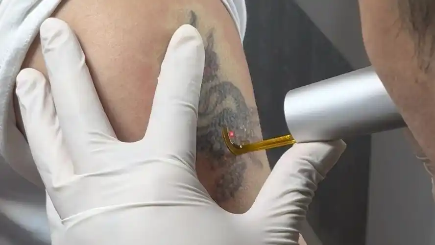 辽宁大连记录洗纹身!