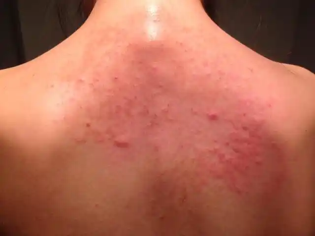 2年前开始后背上长了一些红癍比较痒涂了点倍他米松药膏