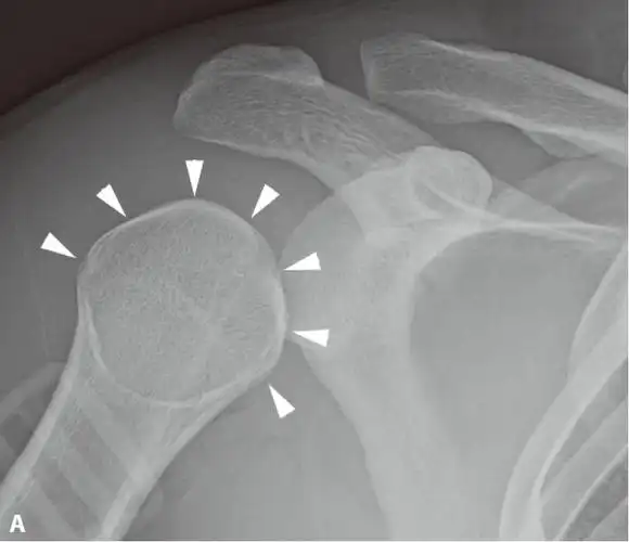 肩关节ap位x线平片显示肱骨头(白箭头)内旋导致的形态变圆("灯泡征").