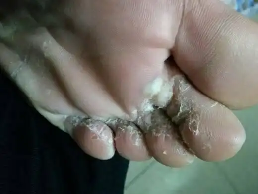 脚怎么会烂成这样子的啊?神马情况导致的呢?