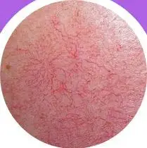 网状型红血丝 特征:面部肌肤受损70% 原因:多为先天原发及角质层受损