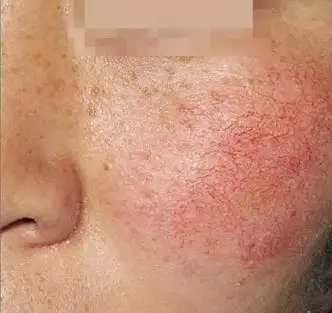 眼红有血丝偏方_小腿外侧血丝偏方_去红血丝偏方