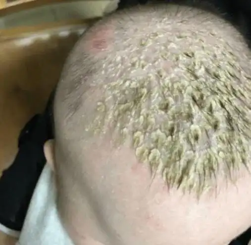 宝秀兰儿童发展中心 的想法: 宝宝有脂溢性皮炎,要如何护理? 1.