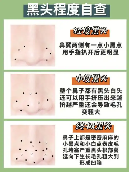 正确去黑头方法不伤毛孔鼻子贼细腻75