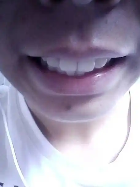 问:请问各位医生,我种牙齿是龅牙吗?还是?