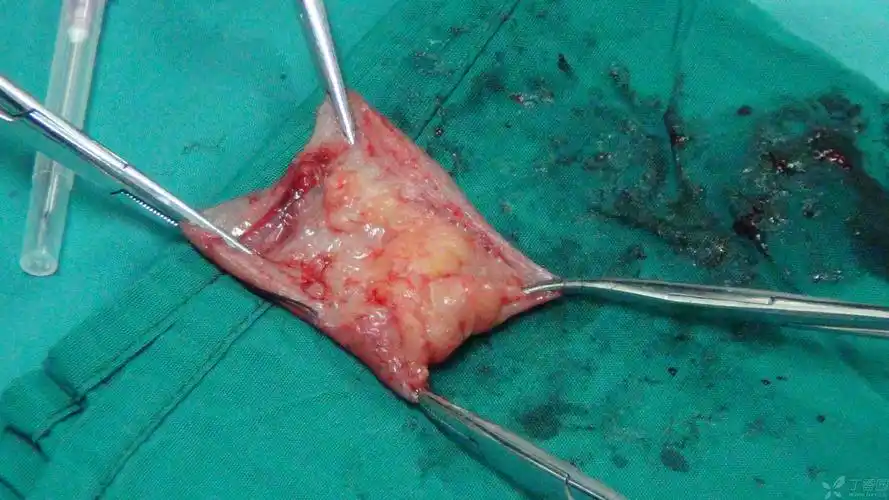 【原创】介绍经肛吻合器技术-pph-starr手术