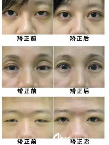 上睑下垂矫正手术多少钱?危险吗?有哪些注意事项