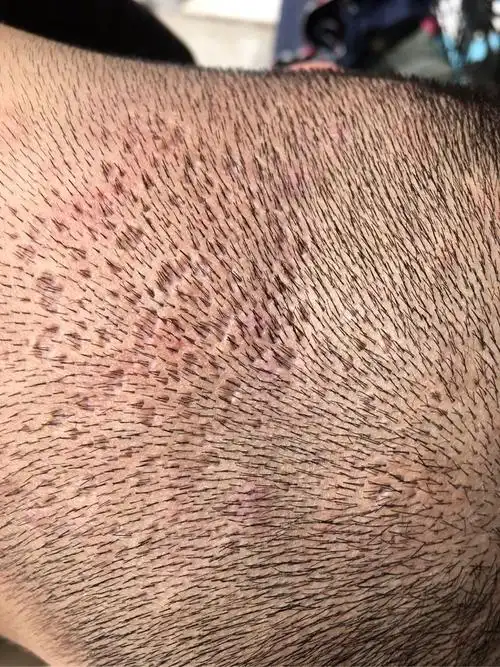 头皮上脂溢性皮炎和毛囊炎共生多年你们有根治的么一起交流一下吧