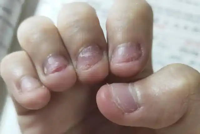 孩子总爱啃咬手指甲,是病态还是习惯?父母要"对症下药"