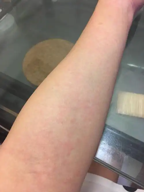 今天突然全身起红疹特别痒