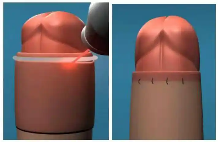 六,手术的选择——二氧化碳激光包皮环切术