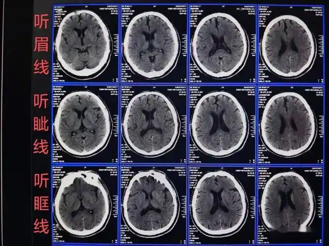 头颅ct扫描时如何打角度才能看得更多更清晰