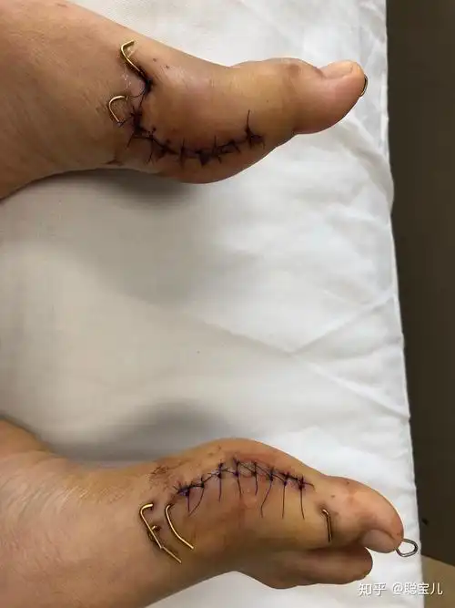 传统拇外翻手术