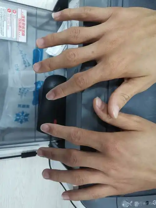 全部手指第二关节肿胀