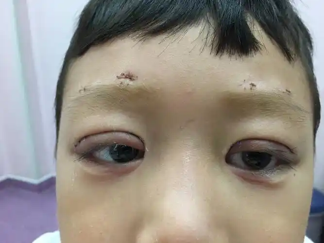 先天性上睑下垂 - 好大夫在线