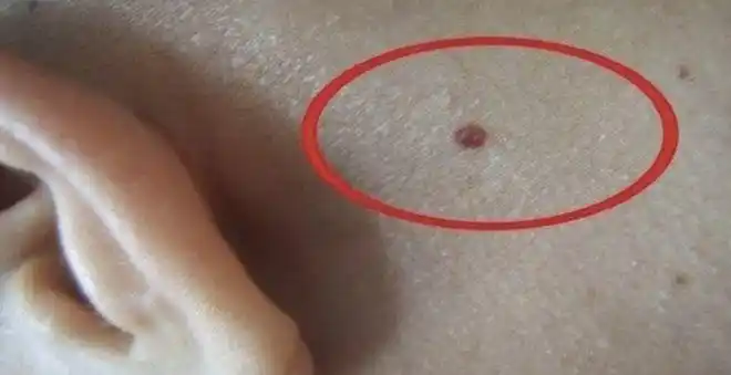 性感撩人的朱砂痣可能是一种病