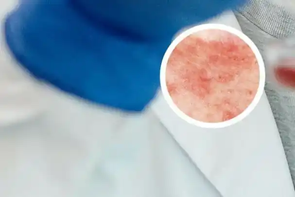 牛皮初期癣症状图片