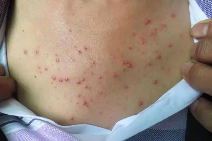 胸口毛囊炎的皮损初起为红色毛囊性丘疹,可表现为疙瘩状,数天内中央