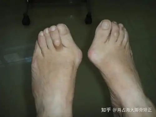 拇外翻大脚骨有哪些症状一起来看看