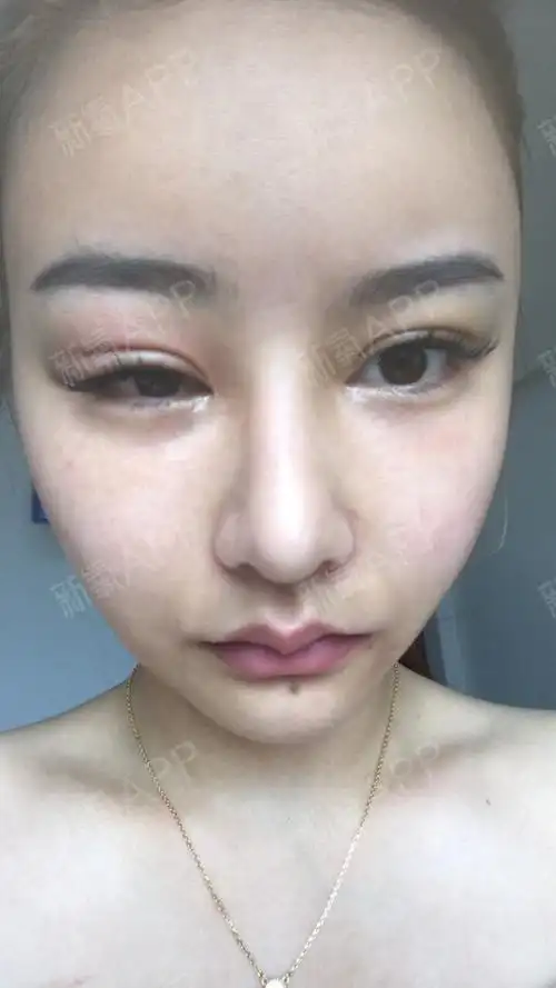 脂肪填充术后半年,脂肪游离到眼皮,导致眼皮睁不开怎么办