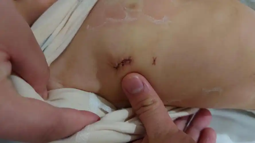 右侧腋下超小微创切口3,大于6毫米的室缺属于大型室缺,不但肺动脉压会