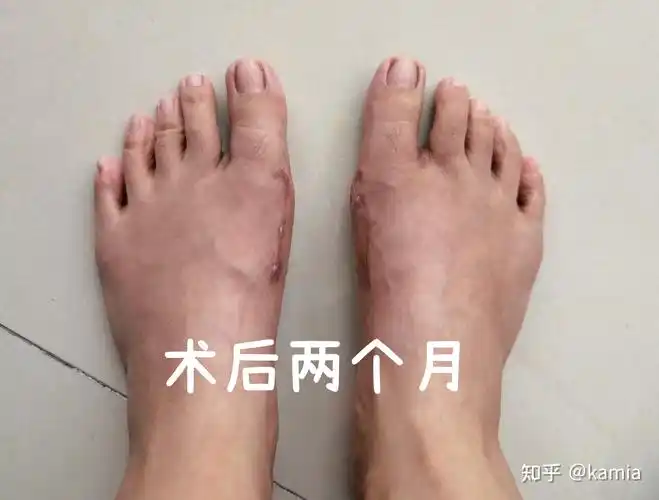 我的双脚拇外翻手术经历术后第二个月
