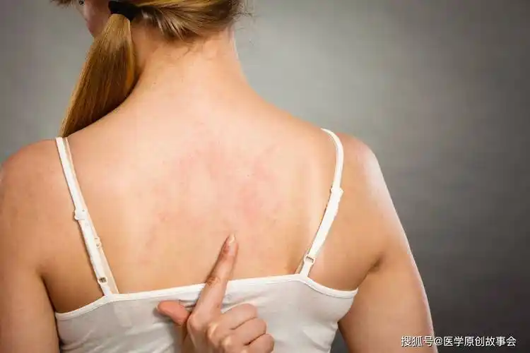 浑身瘙痒,确诊淋巴瘤,提醒:2处发痒,可能是癌症预警_皮肤_症状_患者