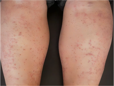 青霉素过敏小腿上出现密集的斑点图