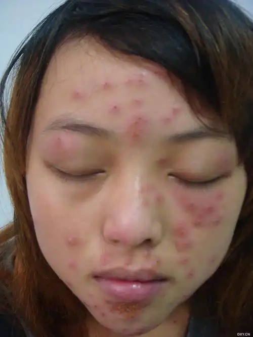 破溃糜烂结痂,三天前始在面部起绿豆黄豆大小的红色炎性丘疹,丘疱疹