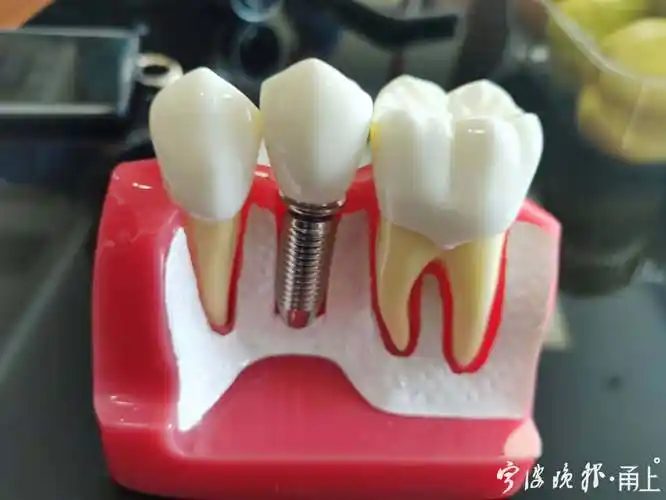 种植牙模型.jpg
