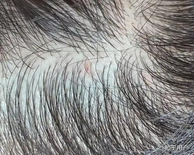 请问得了头部脂溢性皮炎经常扣那些小疙瘩会怎么样