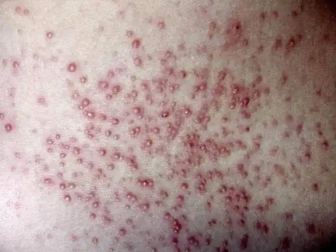 前胸后背,头皮,私处反复长红疙瘩,小心是毛囊炎作祟_医生_治疗_症状