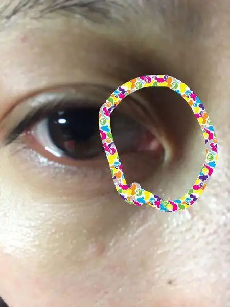 请问我这是正常还是眼角怎么问题?