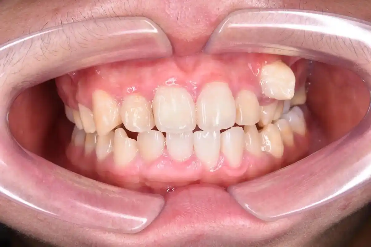 尖牙"虎牙"长歪了,经常有被误拔或被要求拔除,除非特殊情况, - 抖音