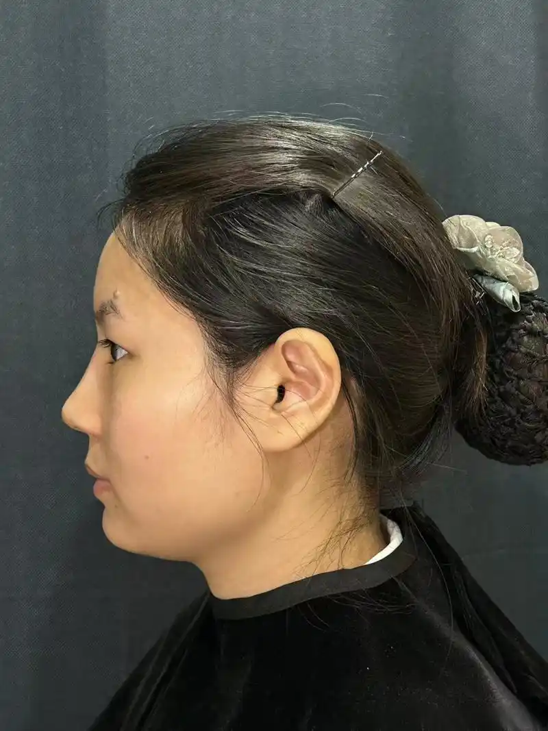 【真实案例分享】塌鼻子怎么样才能做出自然好看的妈生鼻  求美者术前