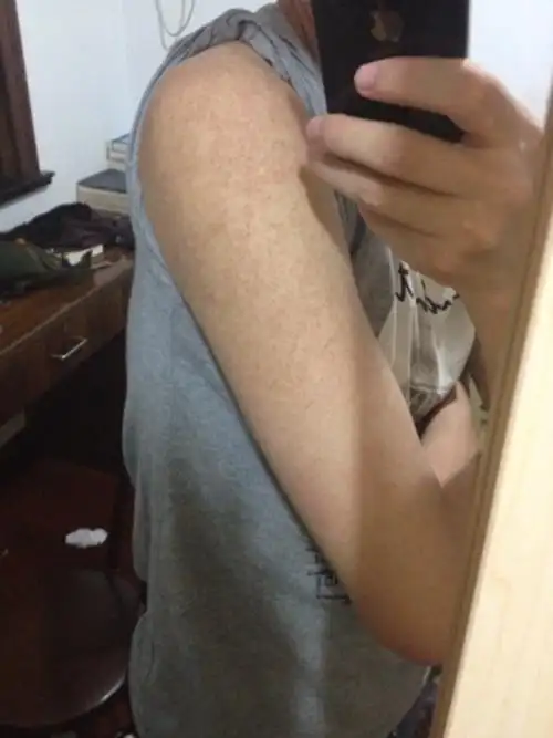 鸡皮肤是天生的彻底治愈对比图片