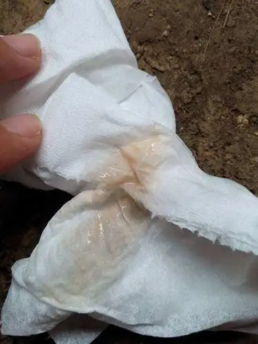 白带带血图片49