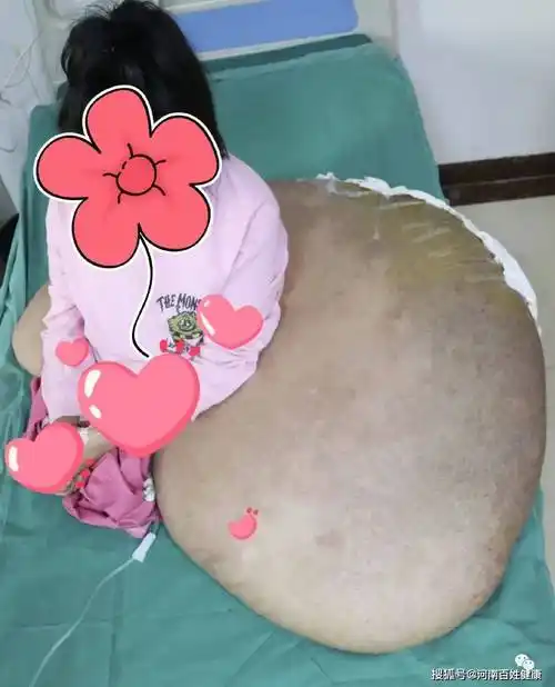 双腿截肢,下半身大如磐石,这个29岁的女孩究竟经历了什么?