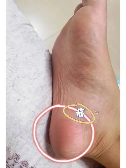 可能是足底筋膜炎!这几种缓解方法,你一学就会!_足部_朋友_影响