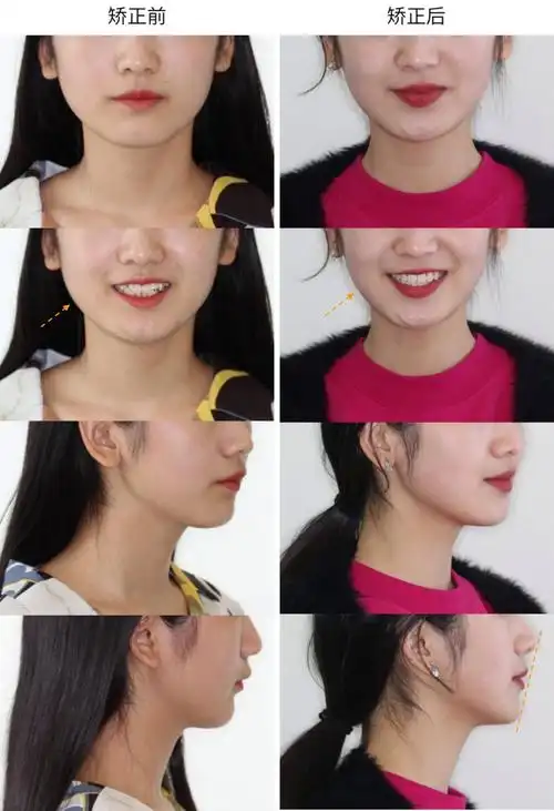 矫正前后面像对比