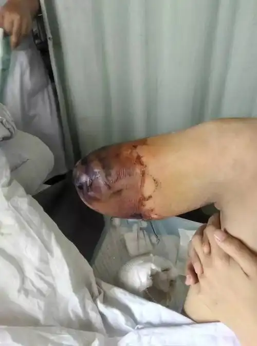 截止手术关乎孩子性命,医生分秒必争与死神赛跑,孩子截肢手术右脚不顺