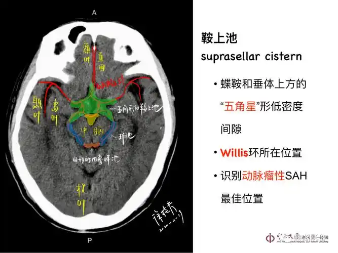 超实用急诊头颅ct3b阅片法