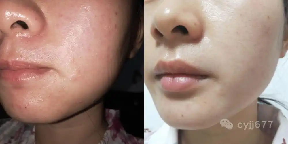 越多,虽然方便了大众,但确实也造成了很多不良后果,一些皮肤病患者,在