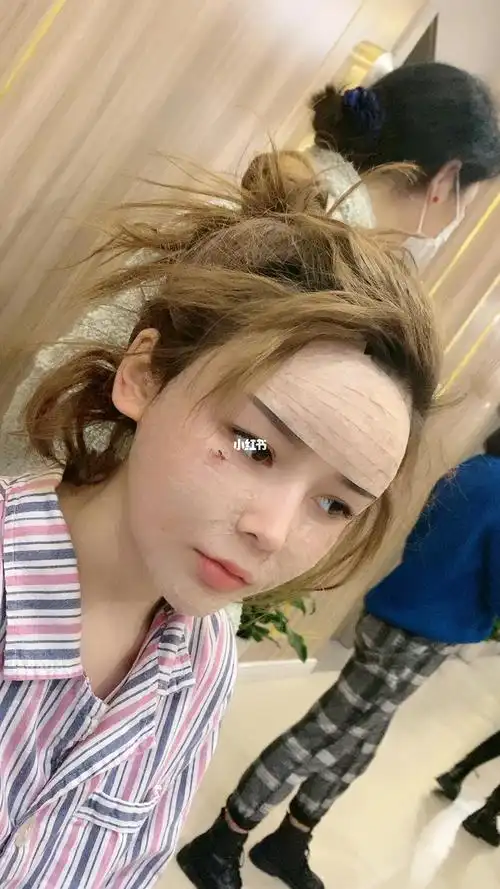 全脸脂肪胶填充术后第二天