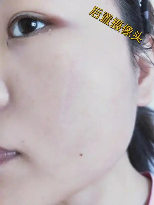 疤痕修复脸部疤痕修复凹陷疤痕又来更新啦