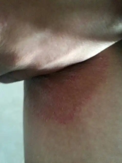 跨下长的,好痒.请问是什么?用什么药来察?